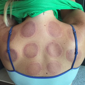 Cupping: the day after